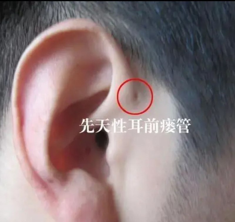 耳朵上的小洞，“粮仓”，学名先天性耳前瘘管，有时候用手揉一揉，千万不要闻手指头，因为很臭🙃，还有千万不要去浏览器搜该关键词，特别是图片！！🙃 #无用但有趣的冷知识