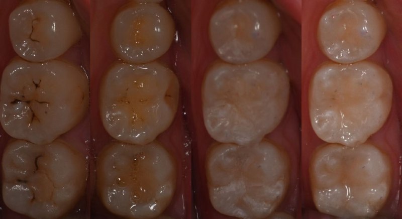 今天朋友圈看到一个医疗机构的宣传图，说是他们医生补的，发过来给大家看看机构的本意是想说明牙齿补的好，很逼真大家可以看看，我承认这个牙从美观上来说恢复的很好但是仅此而已1.这个案例最最关键的问题是什么？大家看出来没有？最关键的是这三颗牙究竟是不是蛀牙？很显然，这三颗牙不是蛀牙，黑色的是什么？是窝沟点隙啊，成年人的窝沟点隙就是有色素的很难说这三颗是蛀牙，应该说是健康的牙齿，只不过色素有点多，或者说只是有蛀牙趋势如果磨了，补了，不但破坏了正常牙体结构，导致更严重的微渗漏，后续反而会加重继发龋的发生蛀牙的鉴别需要用探针勾到粗糙的手感，而不是看到黑的就磨了图上的病人，只需要教导他需要更认真刷牙，半年一年复查就行了，真的出现蛀牙了再补，现在只是可能会引起蛀牙，只需要良好的口腔卫生习惯，就不会导致蛀牙的2.假设这几颗牙是蛀牙，我们需不需要磨除这么多牙体组织？很显然，最新的前沿研究证明是不需要的存在很多医生想当然认为只要是黑色的组织，都要磨除，磨干净为止这是极其错误的，太激进了，太过度了前沿文献表明，蛀牙只需要去除软的腐败组织，可以保留洞底硬的变色组织，它们并不会继续导致蛀牙 #你不知道的行业内幕