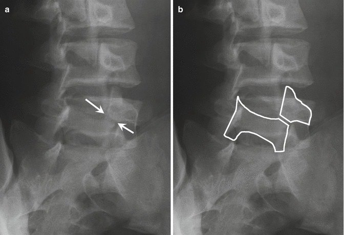 每个人的腰椎上都有一只小狗（苏格兰犬）椎弓断裂