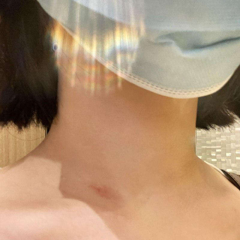 朋友们这个叫湿疹不是你们“喔唷”的那个高级玩意儿🤦🏻‍♀️🤦🏻🤦🏻‍♂️ #无用但有趣的冷知识