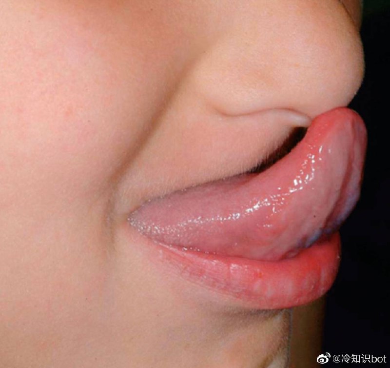 人群中约10%的人能用舌尖碰到鼻子，这一现象甚至还有一个名字，叫“Gorlin's Sign”