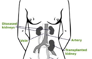 通常，接受肾移植后患者体内会有三个肾，因此换肾手术其实是“加肾手术”